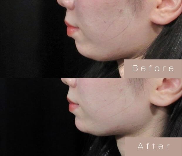 顎ヒアルロン酸