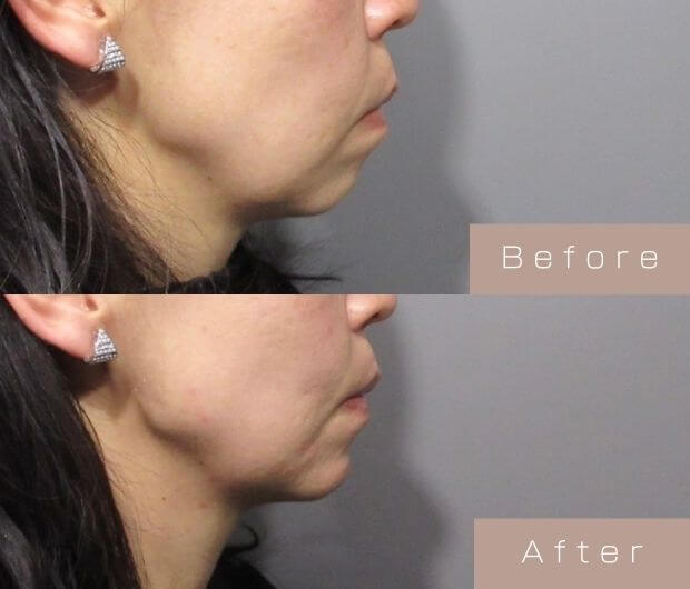 顎ヒアルロン酸
