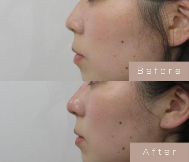 鼻ヒアルロン酸