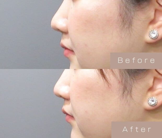 鼻ヒアルロン酸