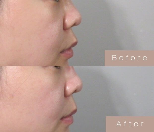 鼻ヒアルロン酸
