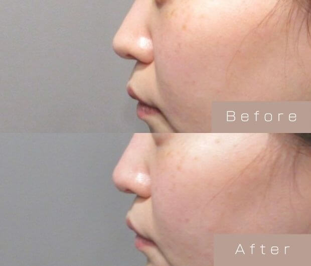 鼻ヒアルロン酸