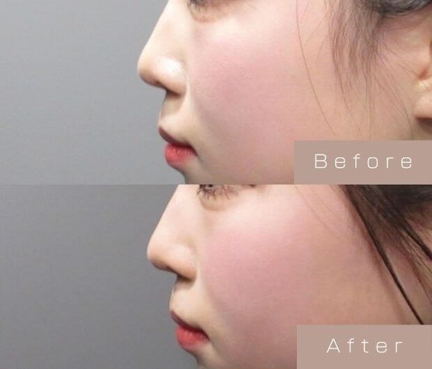 鼻ヒアルロン酸