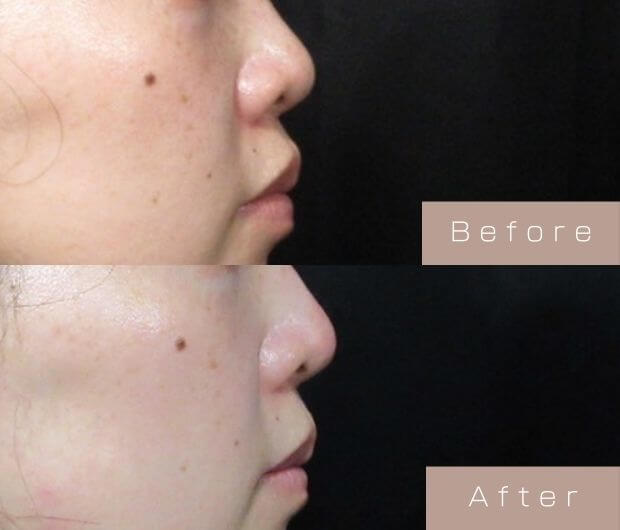 鼻ヒアルロン酸
