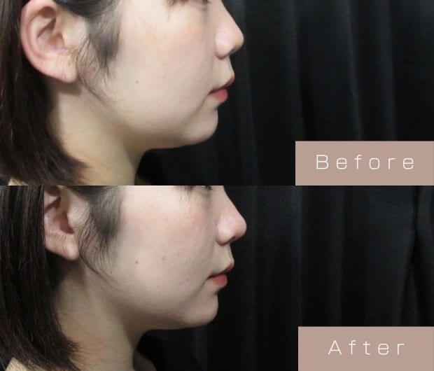 鼻・顎ヒアルロン酸