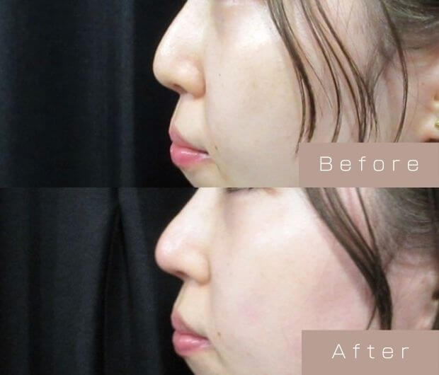 鼻ヒアルロン酸