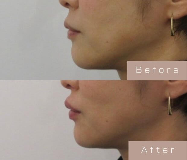 Eライン形成（Cカールリップ＋顎ヒアルロン酸）