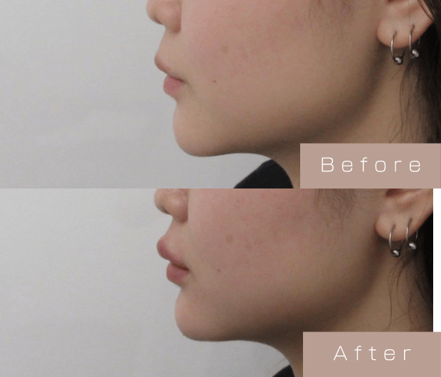 Eライン形成（Cカールリップ＋顎ヒアルロン酸）