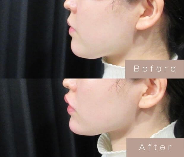 Eライン形成（Cカールリップ＋顎ヒアルロン酸）