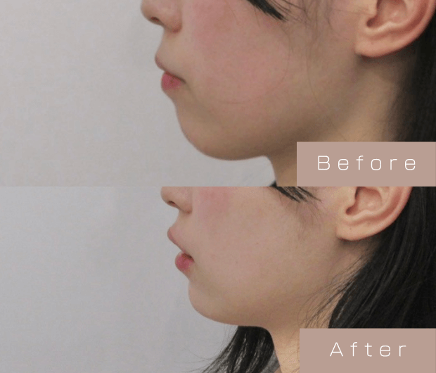 Eライン形成（Cカールリップ＋顎ヒアルロン酸）