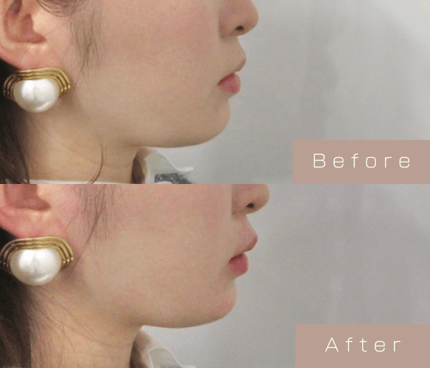 Eライン形成（Cカールリップ＋顎ヒアルロン酸）