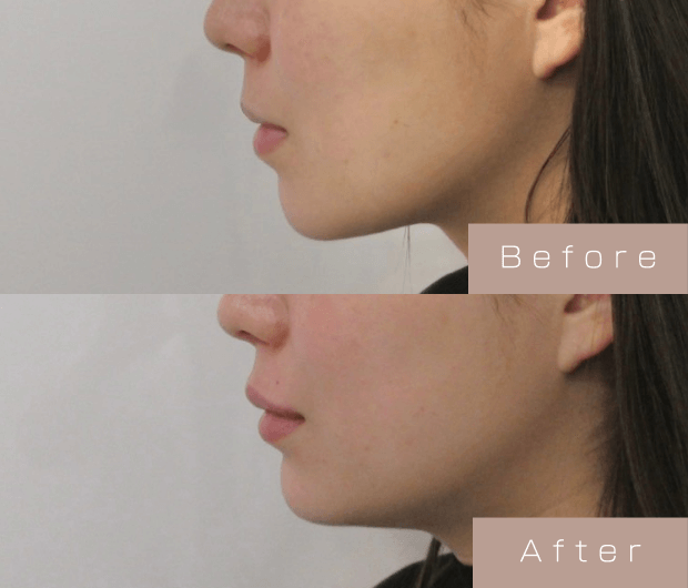 Eライン形成（Cカールリップ＋顎ヒアルロン酸）