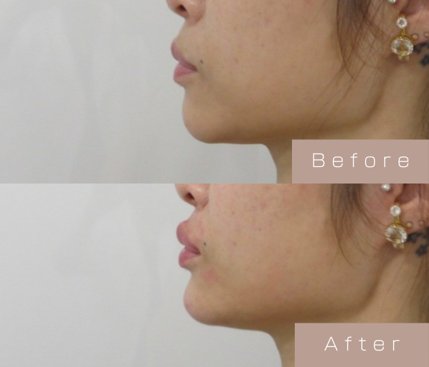 Eライン形成（Cカールリップ＋顎ヒアルロン酸）