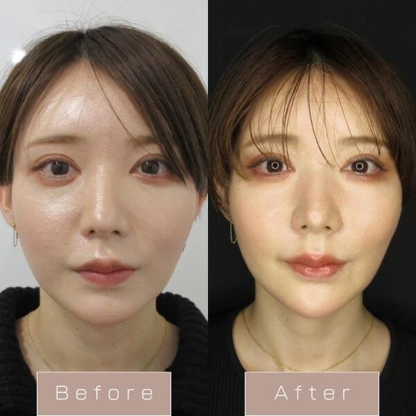 PDO6本＋顎ヒアルロン酸