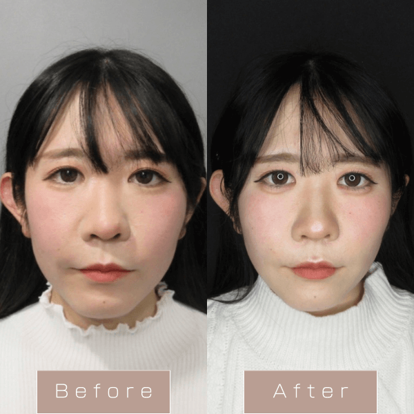 糸リフト（WPCL）８本