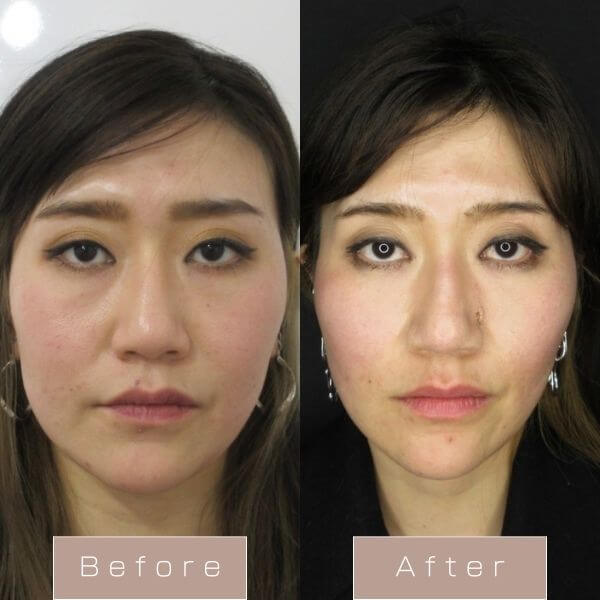 糸リフト（WPCL）８本