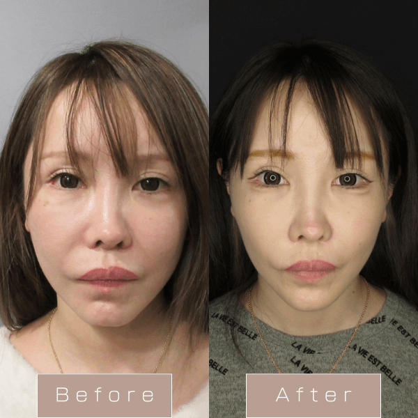 糸リフト（WPCL）８本