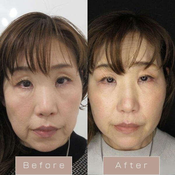 糸リフト（WPCL）８本