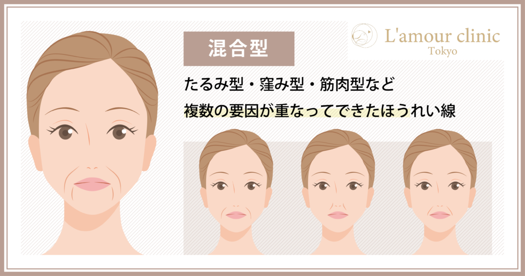 ほうれい線　混合型