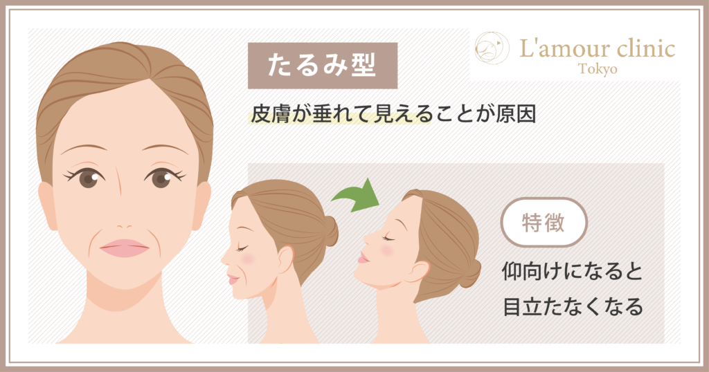 ほうれい線　たるみ型　