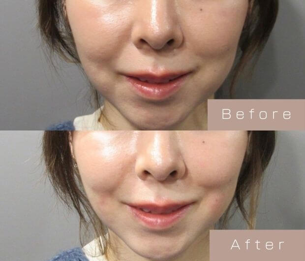 ほうれい線ヒアルロン酸