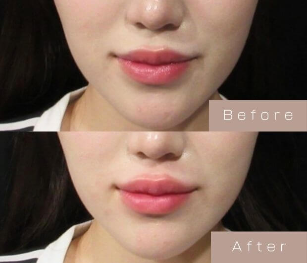 スマイルリップ