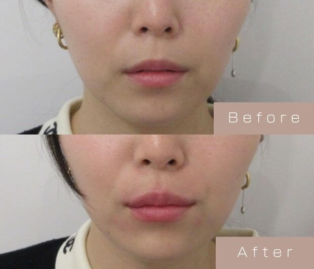 スマイルリップ