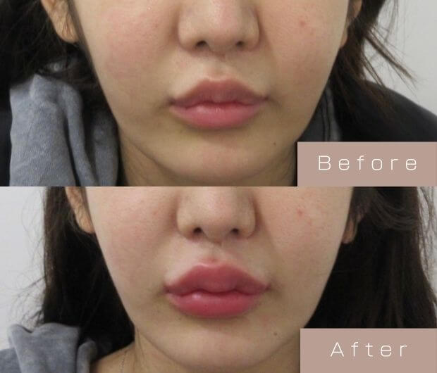 スマイルリップ