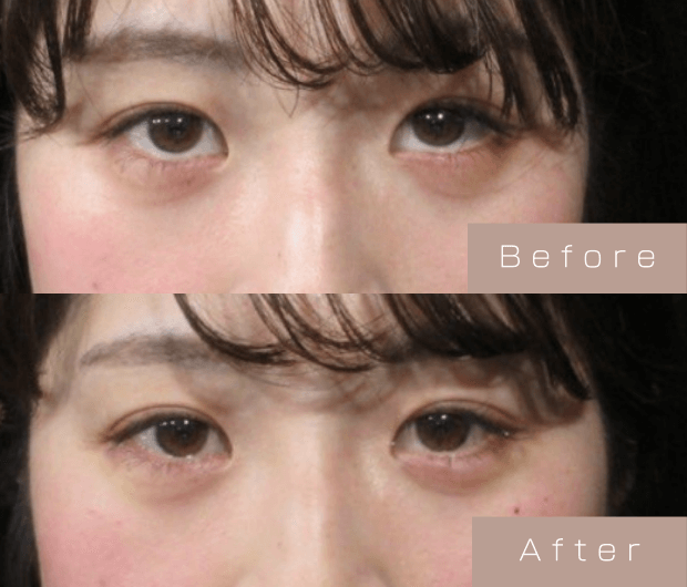 タレ目形成（涙袋ヒアルロン酸＋タレ目ボツリヌストキシン）