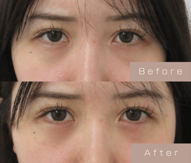 タレ目形成（涙袋ヒアルロン酸＋タレ目ボツリヌストキシン）