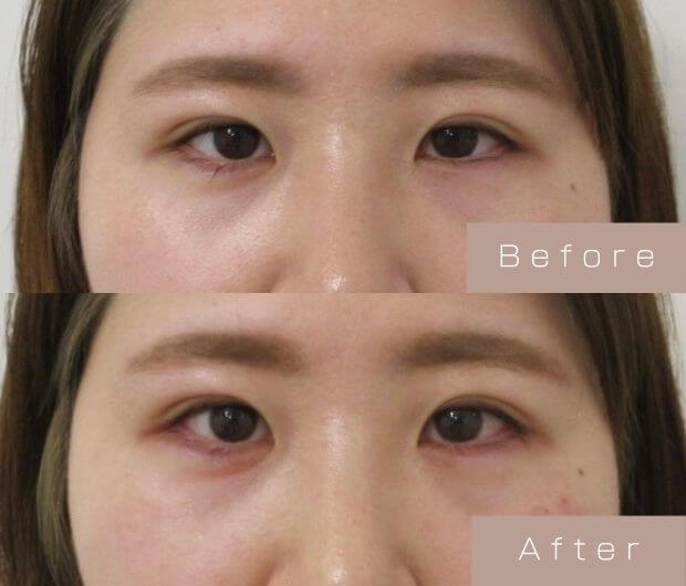 タレ目形成（涙袋ヒアルロン酸＋タレ目ボツリヌストキシン）