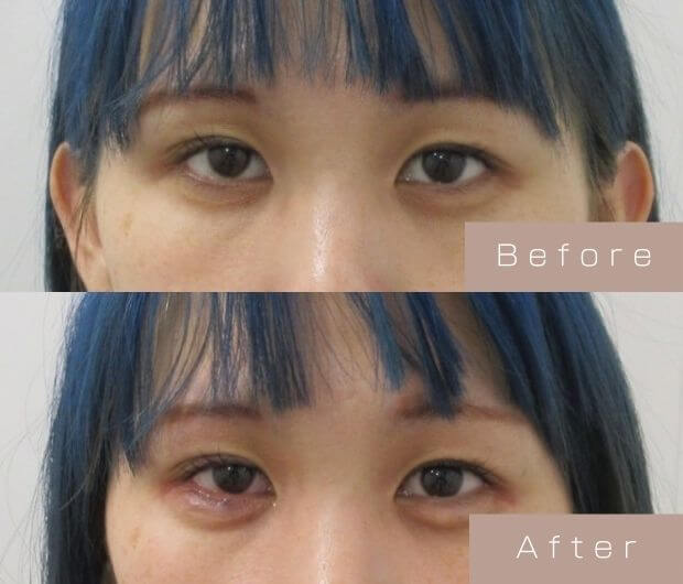 タレ目形成（涙袋ヒアルロン酸＋タレ目ボツリヌストキシン）