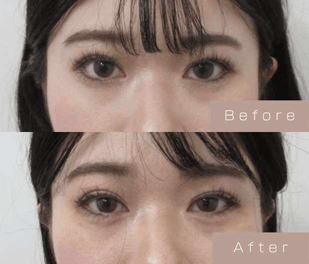 タレ目形成（涙袋ヒアルロン酸＋タレ目ボツリヌストキシン）