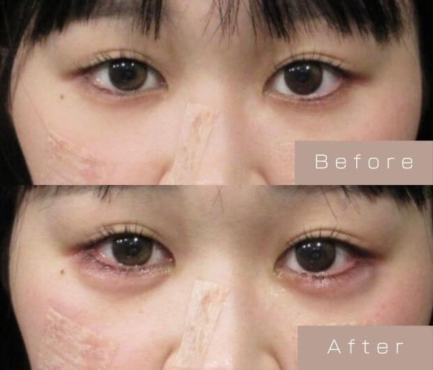 タレ目形成（涙袋ヒアルロン酸＋タレ目ボツリヌストキシン）