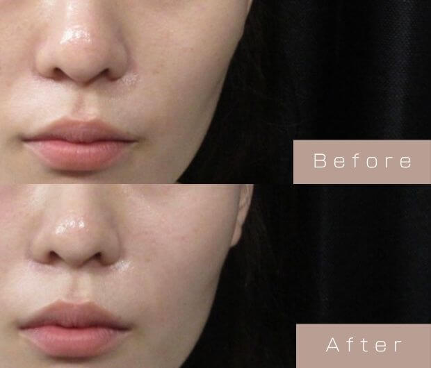 頬ヒアルロン酸