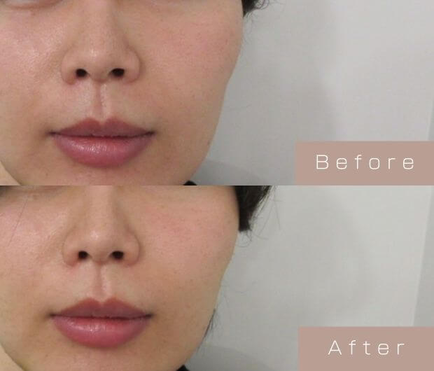 頬ヒアルロン酸