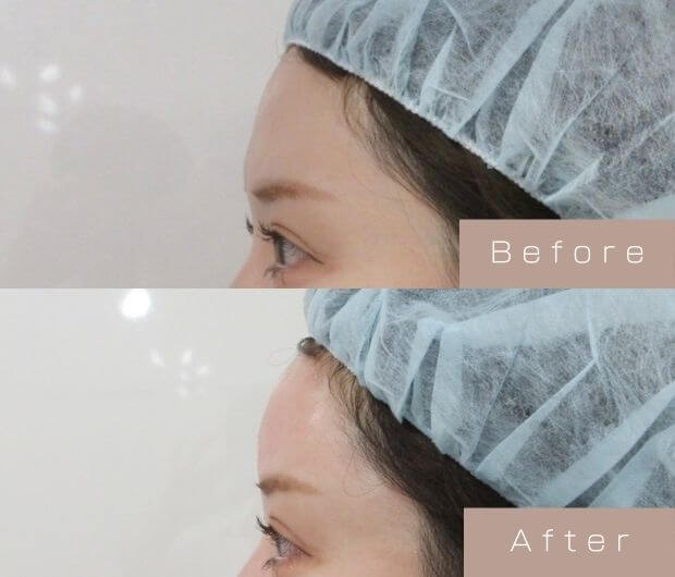 額ヒアルロン酸