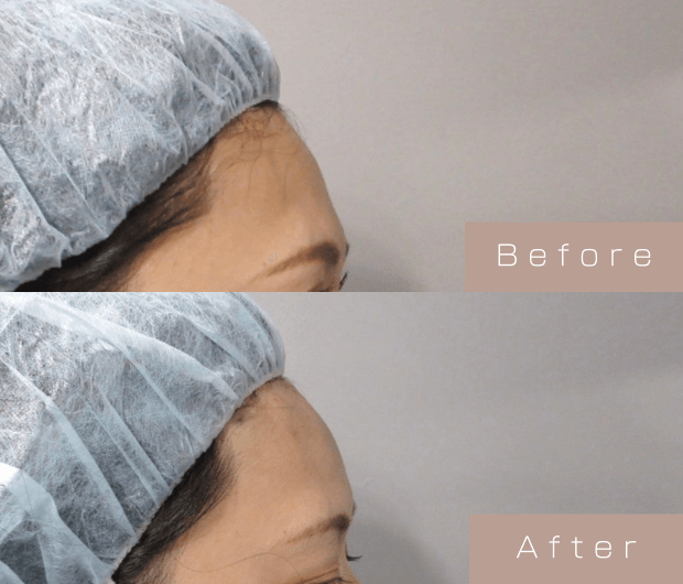 額ヒアルロン酸