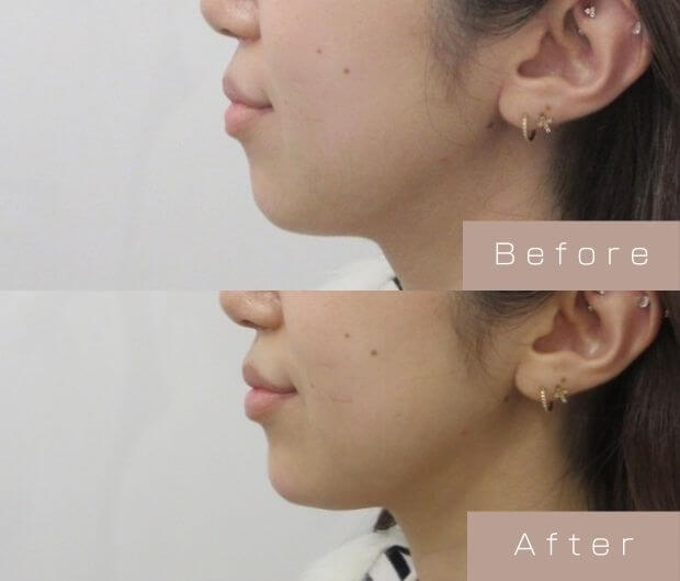 顎ヒアルロン酸