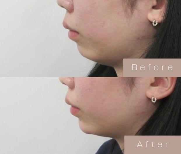 顎ヒアルロン酸