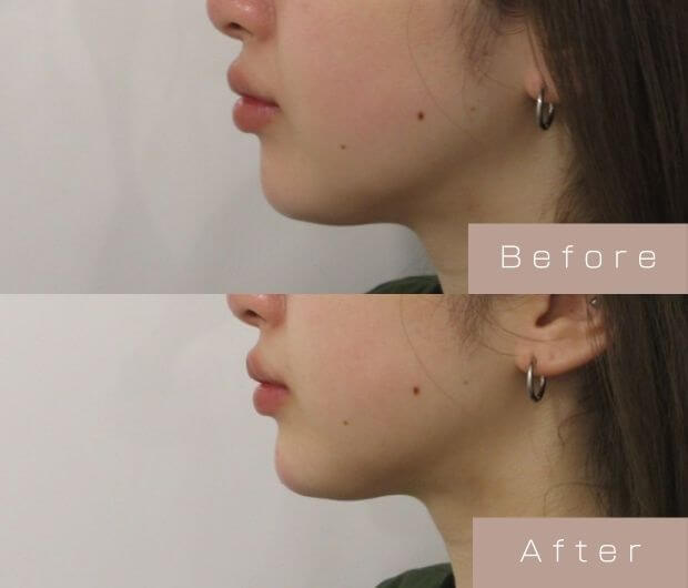 顎ヒアルロン酸