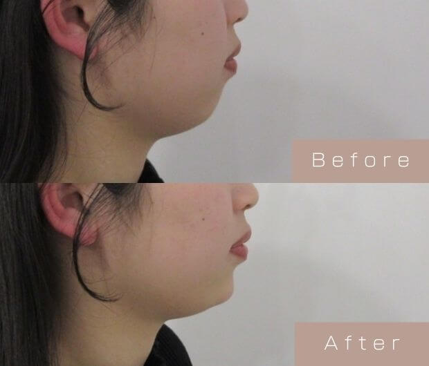 顎ヒアルロン酸