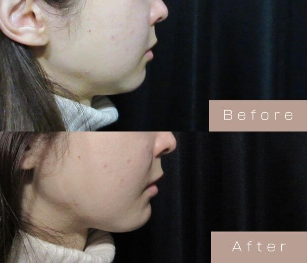 顎ヒアルロン酸