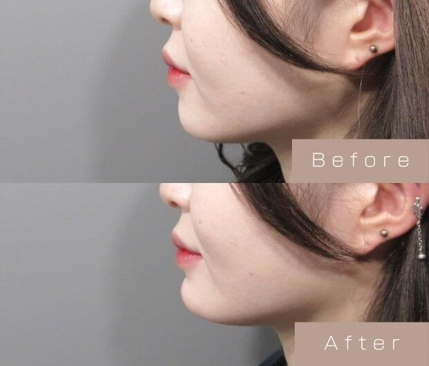 顎ヒアルロン酸