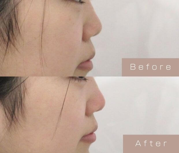 鼻ヒアルロン酸