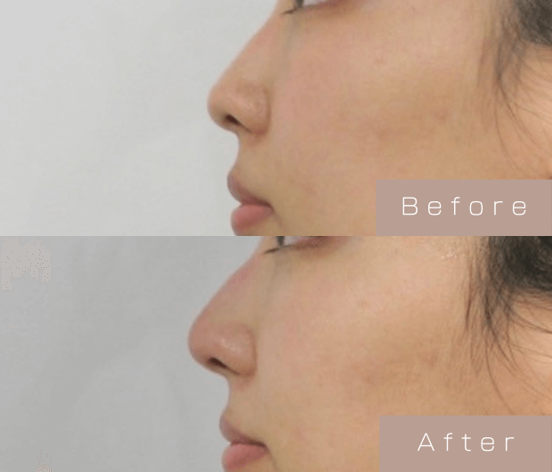 鼻ヒアルロン酸