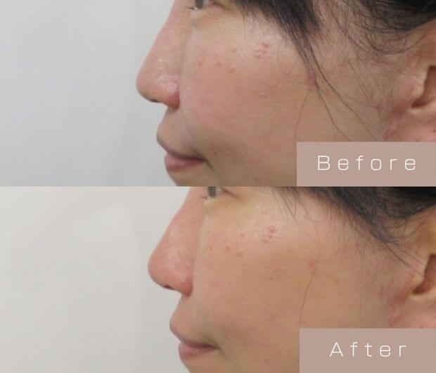 鼻ヒアルロン酸