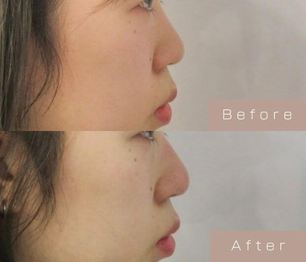 鼻ヒアルロン酸