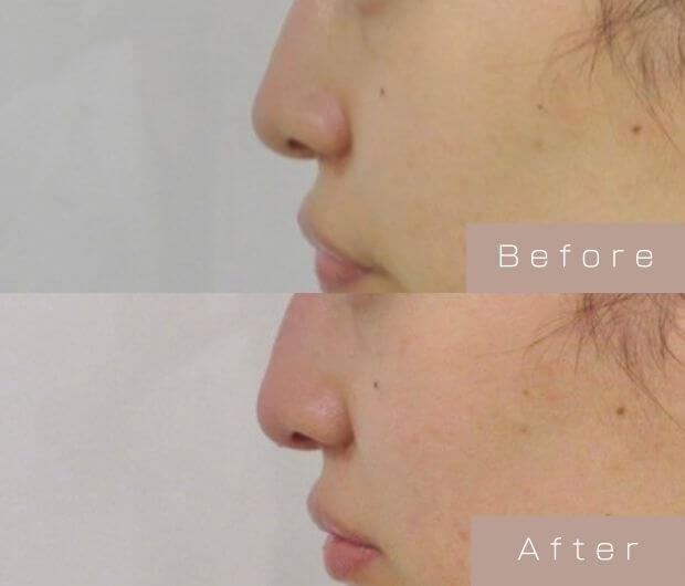 鼻ヒアルロン酸