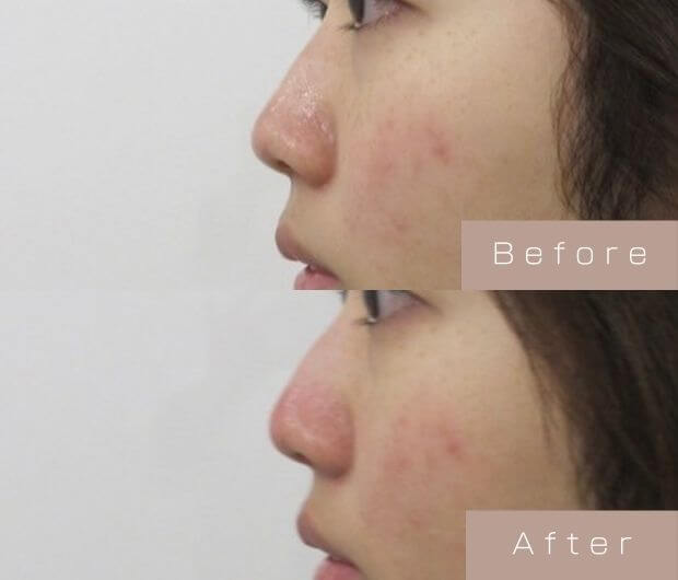 鼻ヒアルロン酸